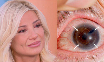 faii-skorda-ti-einai-o-keratokonos-me-ton