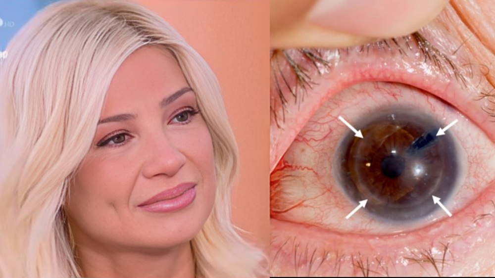 faii-skorda-ti-einai-o-keratokonos-me-ton