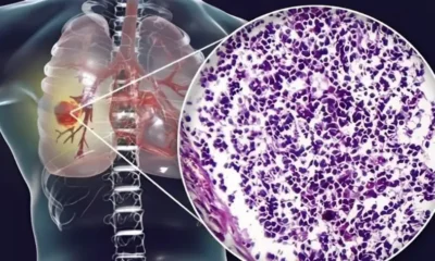 o-aoratos-kivduvos-ti-koino-yliko-kouzinas-syndeetai-me-kapkivo-pnevmona-pposoxn-sto-spiti-sas