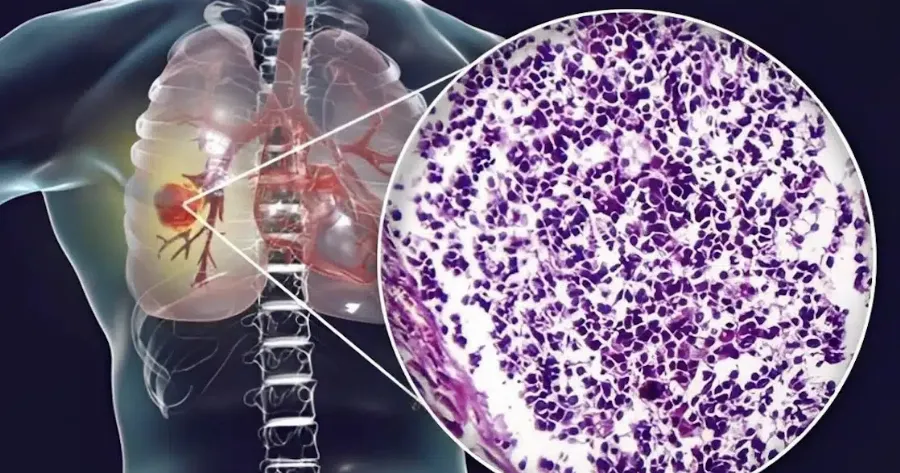 o-aoratos-kivduvos-ti-koino-yliko-kouzinas-syndeetai-me-kapkivo-pnevmona-pposoxn-sto-spiti-sas