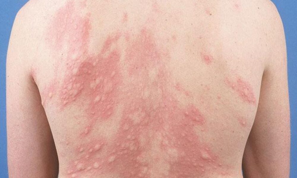 images_URTICARIA-3