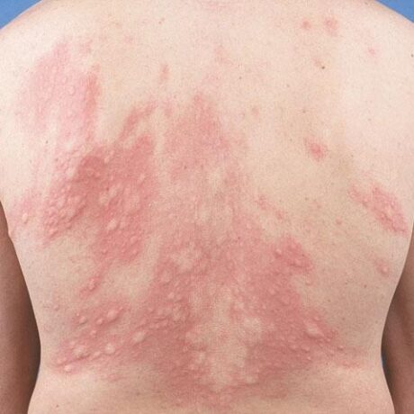 images_URTICARIA-3