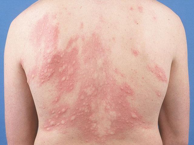 images_URTICARIA-3