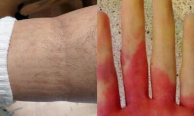 anakopi-kardias-6-proeidopoiitika-simadia