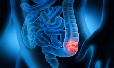 simadia-karkinou-tou-pacheos-enterou-8211-ta-symptomata