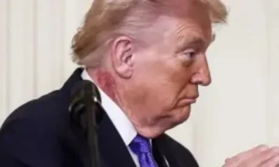 pagkosmia-anisychia-gia-tin-ygeia-tou-ntonalnt-trab-ti-simainei-to-exanthima-pou-echei-sto-laimo-tou