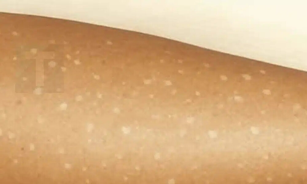 lefkes-kilides-sto-derma-poies-elleipseis-vitaminon-borei