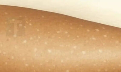 lefkes-kilides-sto-derma-poies-elleipseis-vitaminon-borei