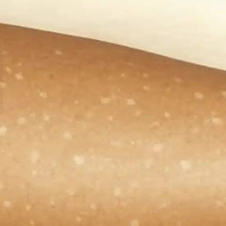 lefkes-kilides-sto-derma-poies-elleipseis-vitaminon-borei