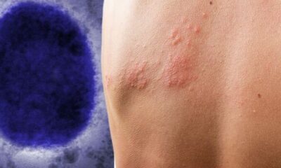 monkeypox-1