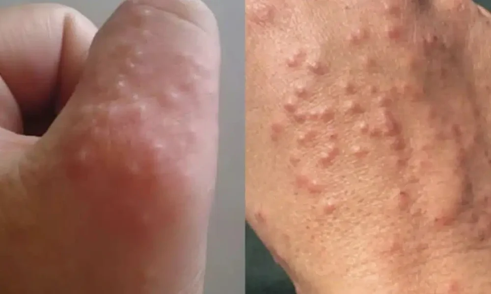 min-agnoeite-tis-mikres-kokkines-kilides-sto-derma_