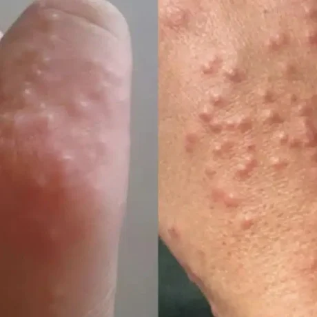 min-agnoeite-tis-mikres-kokkines-kilides-sto-derma_