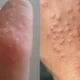 min-agnoeite-tis-mikres-kokkines-kilides-sto-derma_