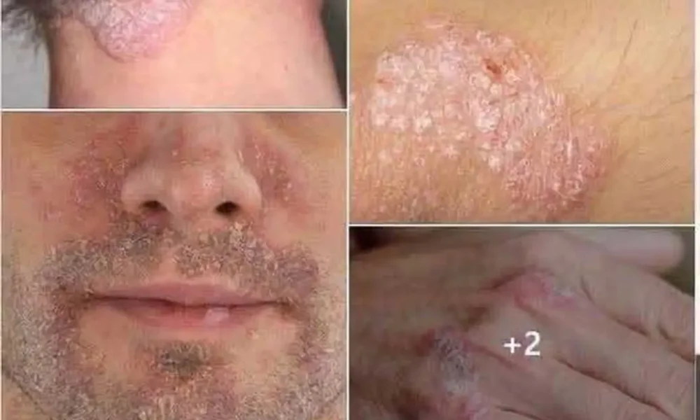 psoriasi-oi-6-trofes-pou-borei-na-epideinonoun-e1784607599664_