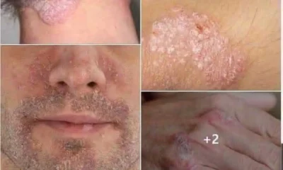 psoriasi-oi-6-trofes-pou-borei-na-epideinonoun-e1784607599664_