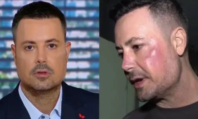 petros-kousoulos-ti-einai-i-gyroeidis-alopekia-pou-ton-talaiporei-i-machi-me-to-aftoanoso-kai-i-nea-diagnosi